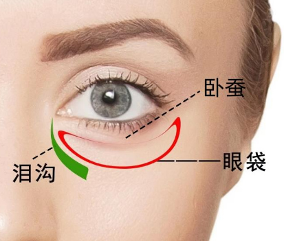 去眼袋手术