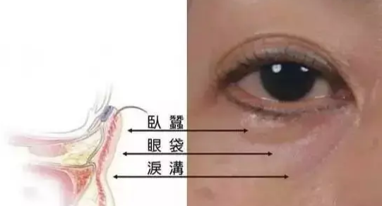 去眼袋手术