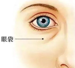去眼袋手术
