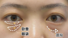 去眼袋手术