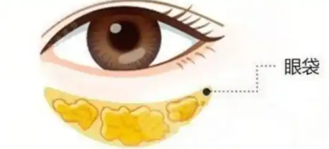 去眼袋手术