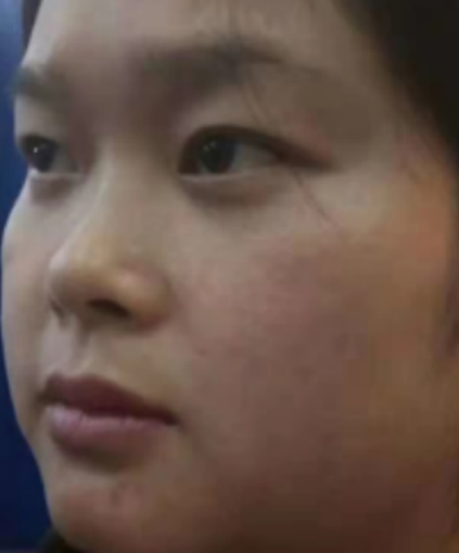 去眼袋手术