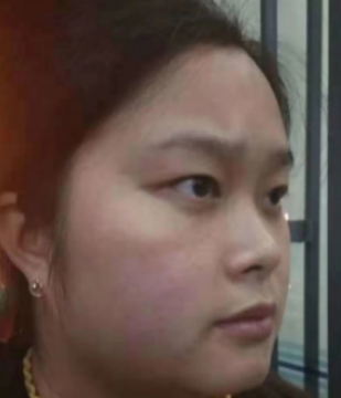 去眼袋手术