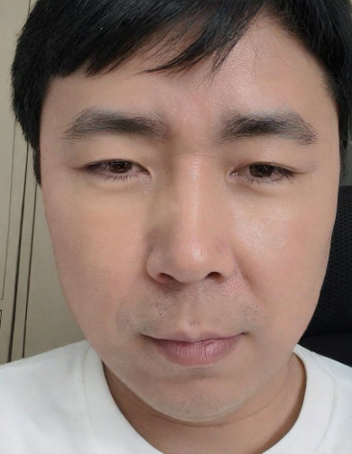去眼袋手术