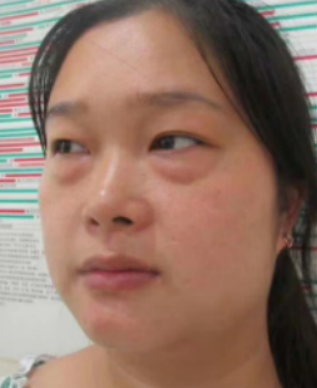去眼袋手术