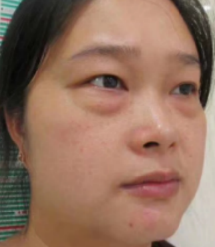去眼袋手术