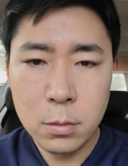 去眼袋手术