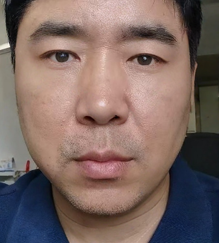 去眼袋手术