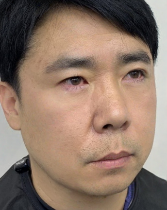 去眼袋手术
