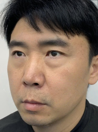 去眼袋手术