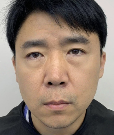 去眼袋手术