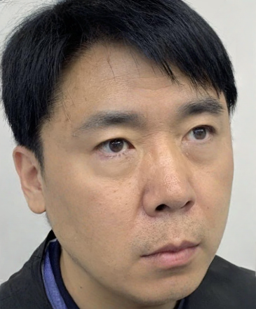 去眼袋手术