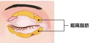 眼袋