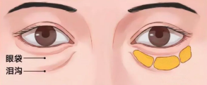 眼袋