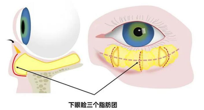 眼袋