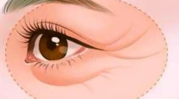 眼袋