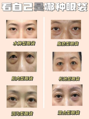眼袋