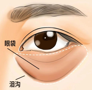 眼袋