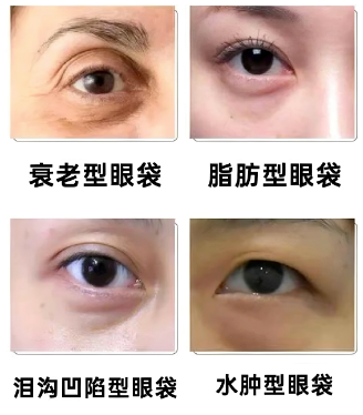 眼袋