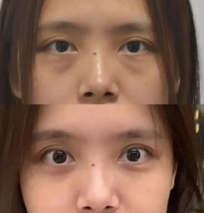 眼袋