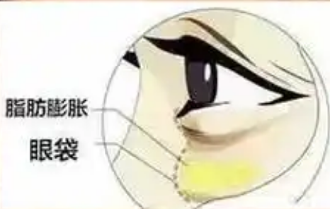 眼袋
