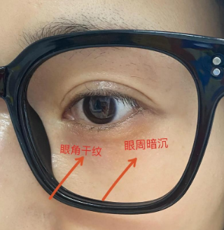 眼袋