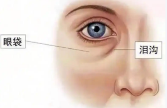 去眼袋手术