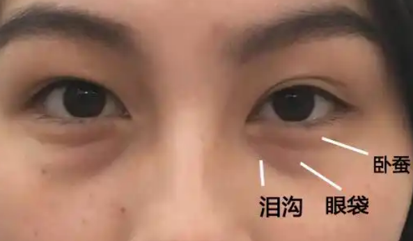 眼袋
