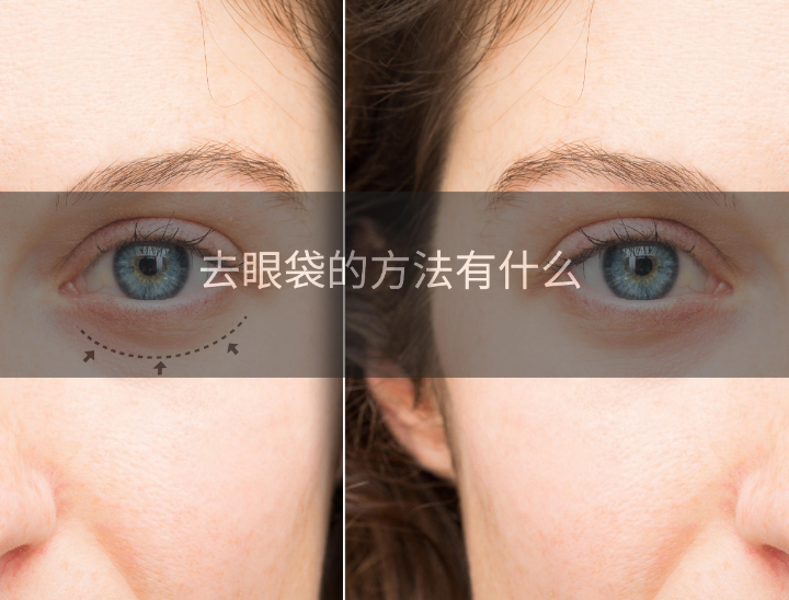 去眼袋手术