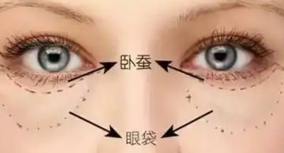 去眼袋手术