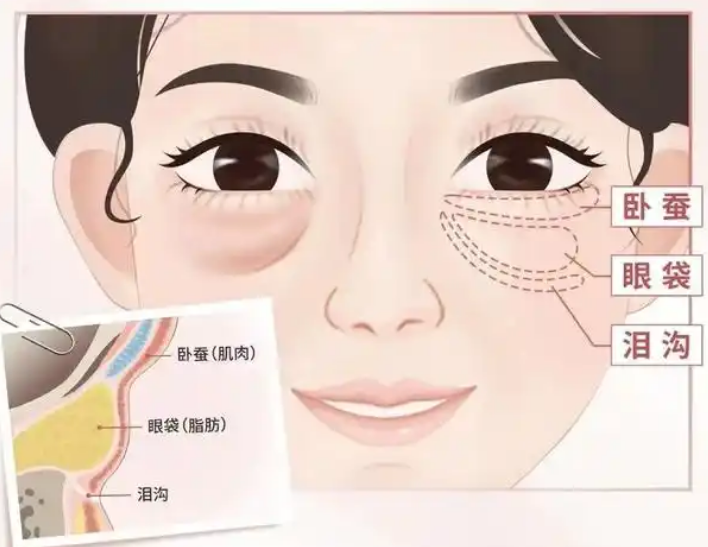 去眼袋手术