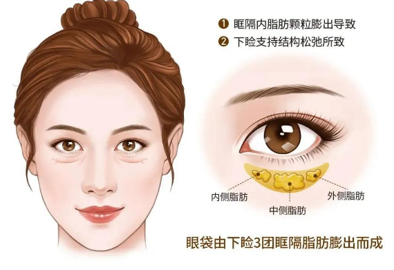 眼袋