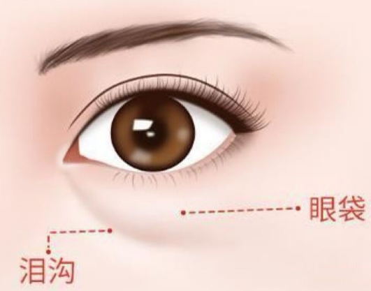 眼袋