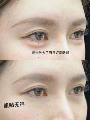 眼袋