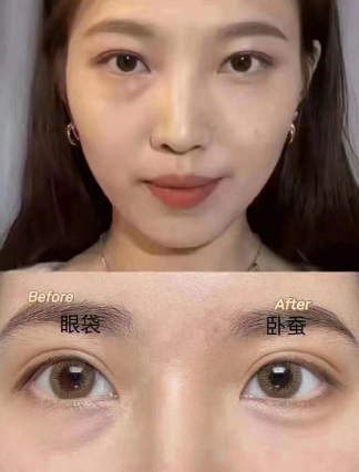 眼袋