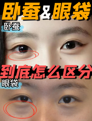 眼袋