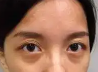 去眼袋手术