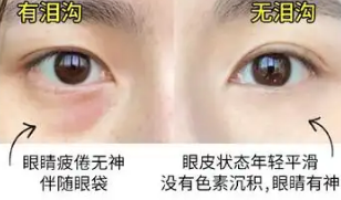 眼袋
