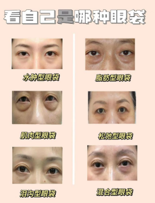 眼袋