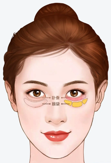 眼袋