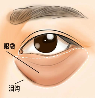 眼袋