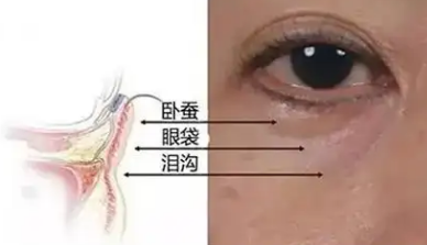 去眼袋手术