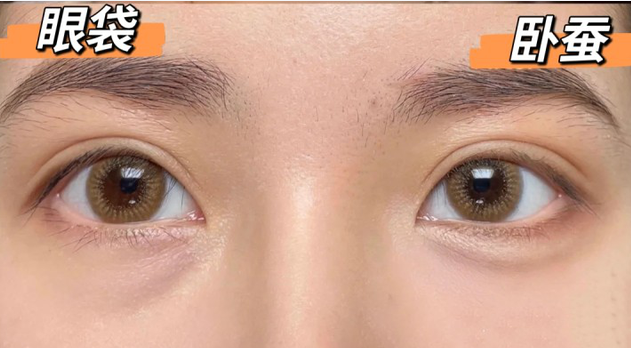 眼袋