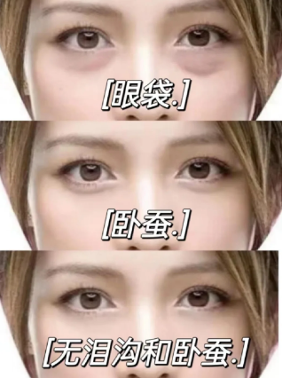 眼袋