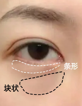 眼袋