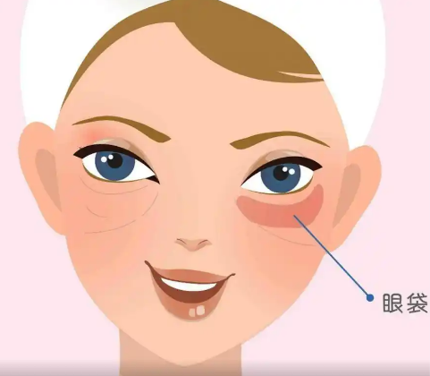 去眼袋手术