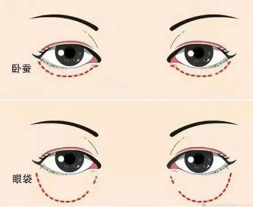 去眼袋手术