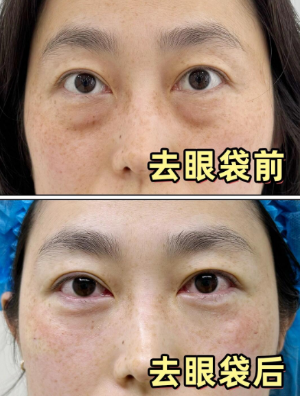 去眼袋手术