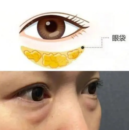 去眼袋手术