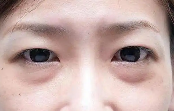去眼袋手术
